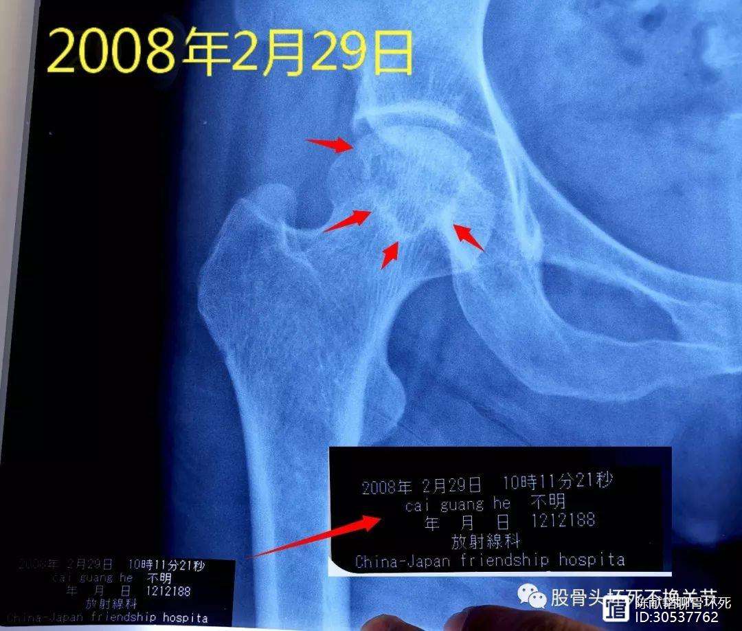 海口人工骨头医保报销多少(人工骨头医保报销多少比例)